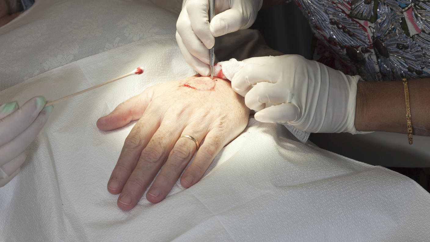 Close-up view of a medical procedure being performed on a person’s hand, showing a healthcare provider using surgical tools while another assists with a cotton swab.