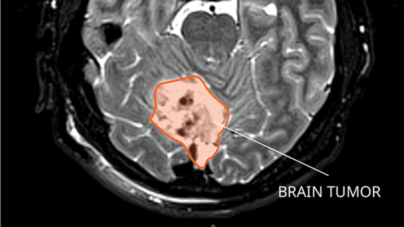 MRI of a medulloblastoma in the brain.
