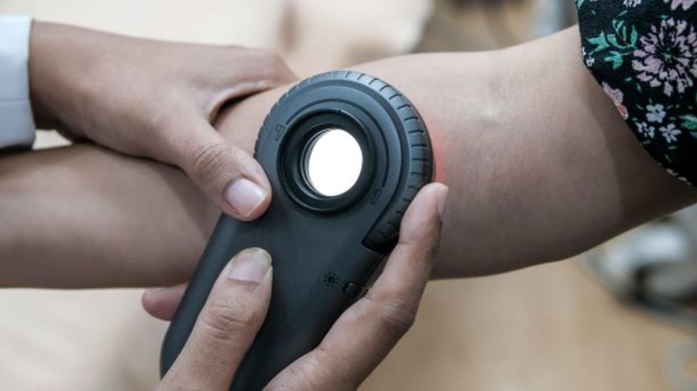 a cropped image of a physician's hand using a dermatoscope to look at a mole.