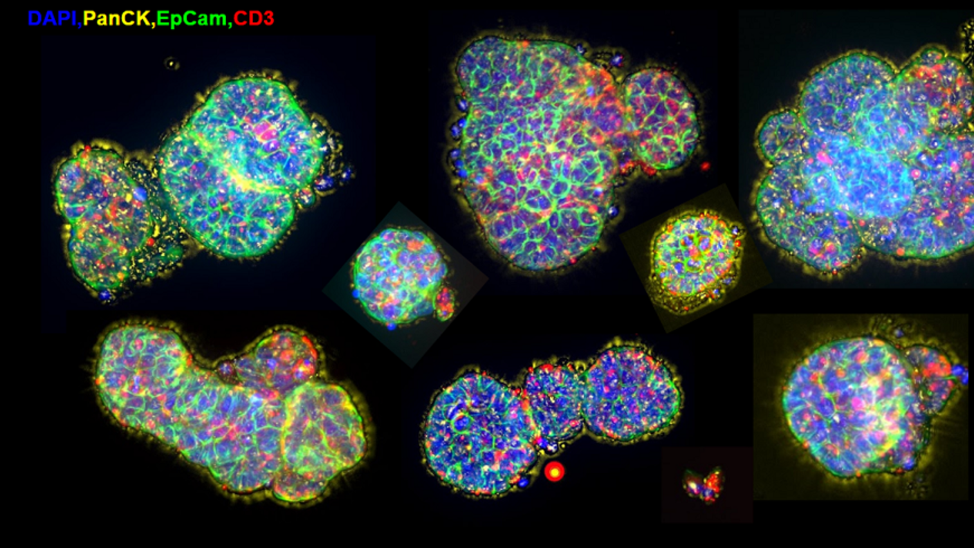 Immunofluorescence images of micro-organospheres created from a human lung tumor.