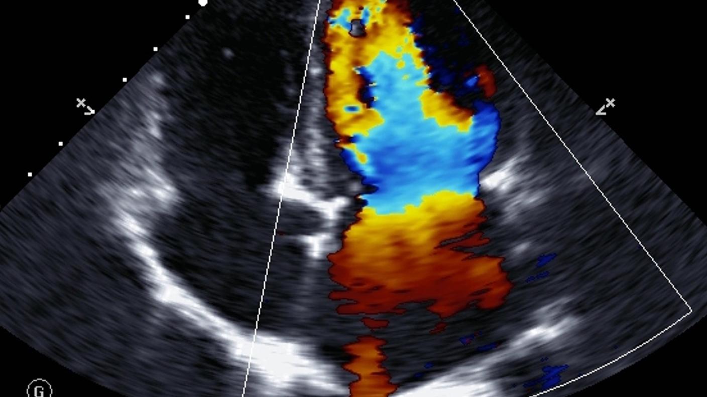 Una ecocardiografía Doppler 