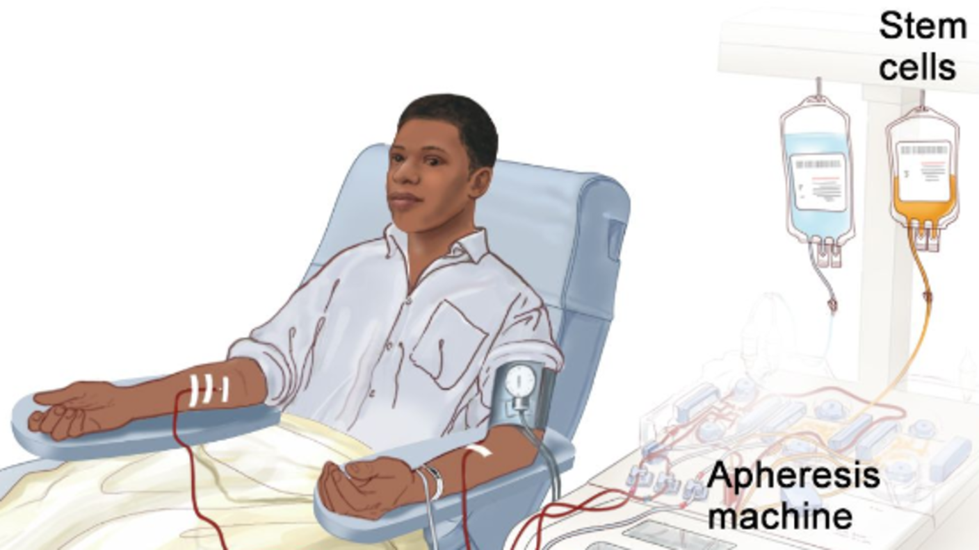 An illustration of a young man undergoing an apheresis procedure for stem cell collection.