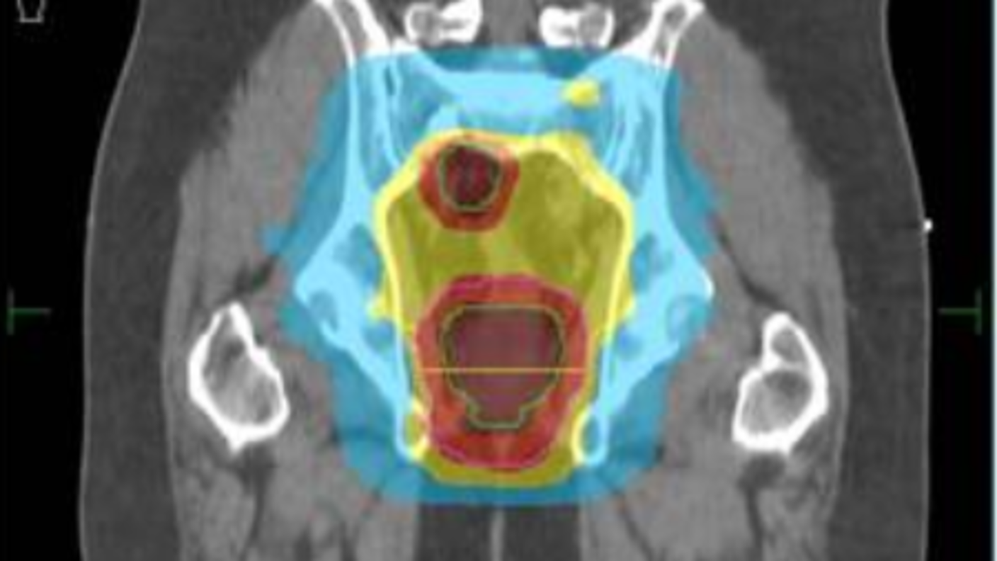 Plan de dosificación de radioterapia de intensidad modulada para un adulto con cáncer de recto.