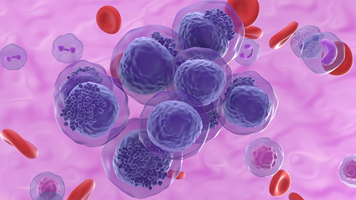 An illustration of AML cells floating among other cells