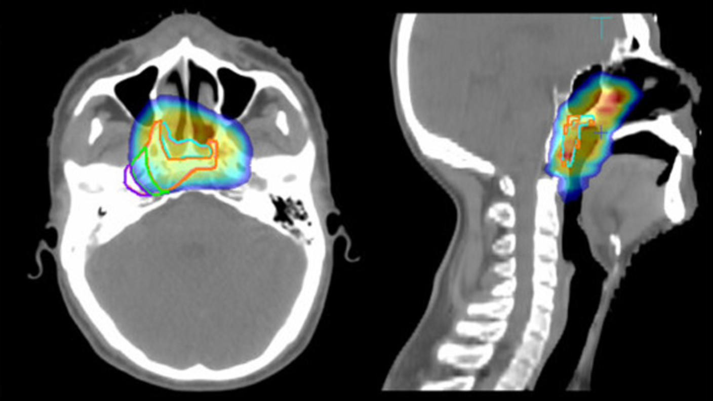 Imaging scans of a nasopharyngeal carcinoma with radiation doses presented in different colors