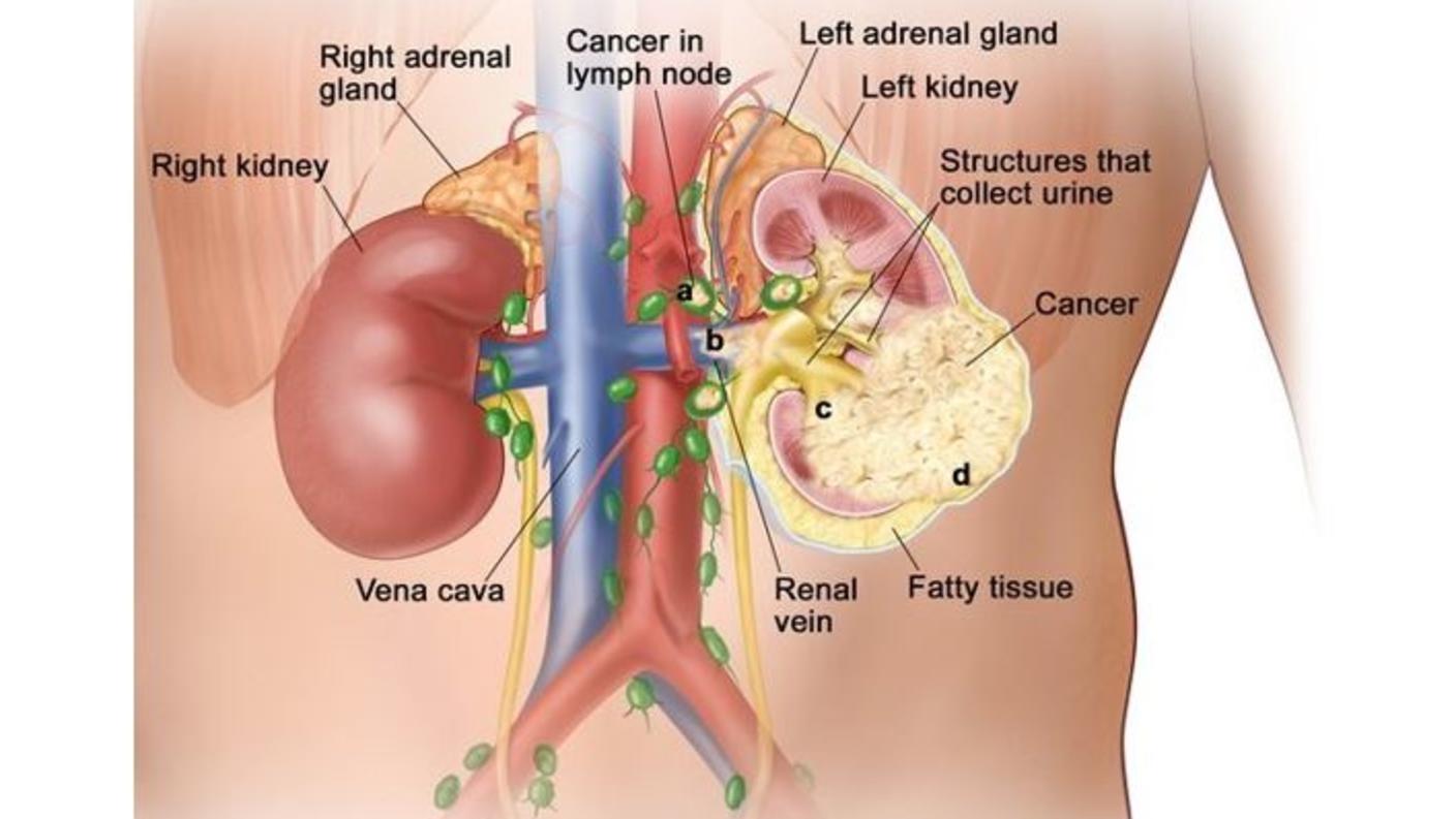 An anatomic illustration of stage 3 kidney cancer