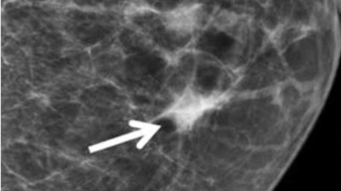 A mammogram showing a focal asymmetry in the breast.
