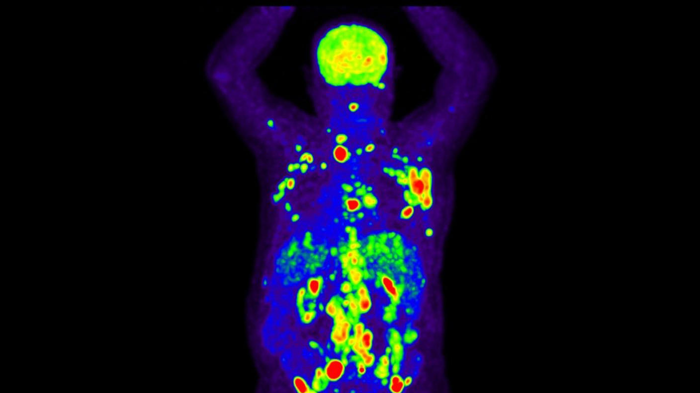 An FDG-PET scan of a man with Hodgkin lymphoma showing cancer (marked by areas of red and yellow-orange) throughout the upper body.