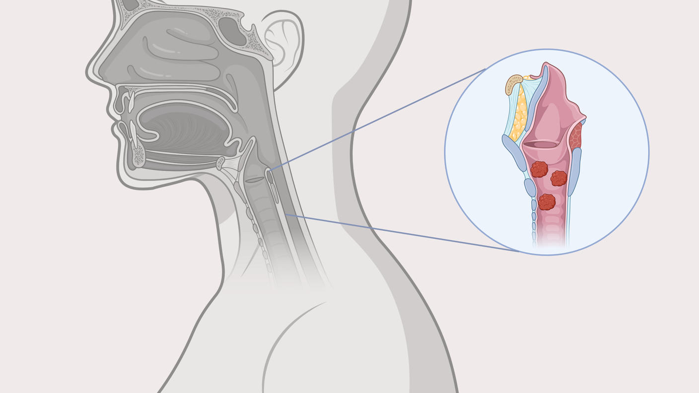 An illustration showing multiple benign tumors in the respiratory tract, characteristic of recurrent respiratory papillomatosis. 