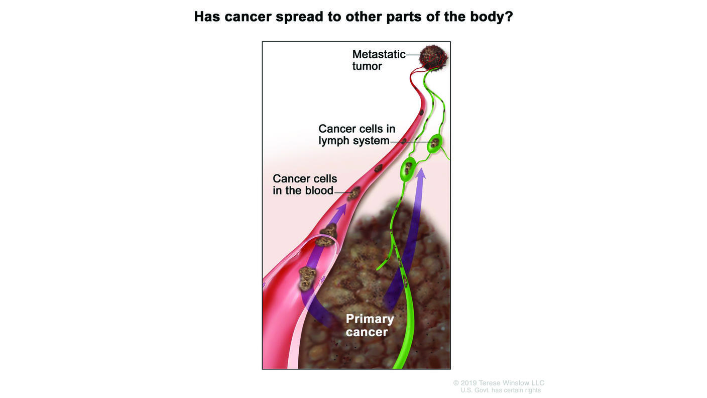 Illustration showing the spread of cancer from a tumor to other parts of the body, with labels showing cancer cells in the lymph system as well as cancer cells in a blood vessel. In the bottom part of the image, there is a large mass labeled "Primary cancer." Arrows indicate the movement of cancer cells from the primary site to the blood and lymphatic systems.