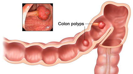 Close-up illustration of a section of the colon with two polyps, which are labeled. A small inset photograph in the top left shows a photo of a colon polyp.
