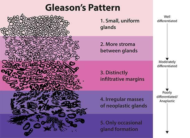 A graphic titled “Gleason’s Pattern”. The graphic has five different rows. A large illustration of cells, mostly uniform and similarly sized at the top, becomes more irregular and oddly shaped towards the bottom. The five steps are: Small uniform glands, to more stroma between glands to more distinctly infiltrative margins to irregular masses of neoplastic plants to only occasional gland formation. On the right, text with arrows moves from well differentiated to poorly differentiated/anaplastic.