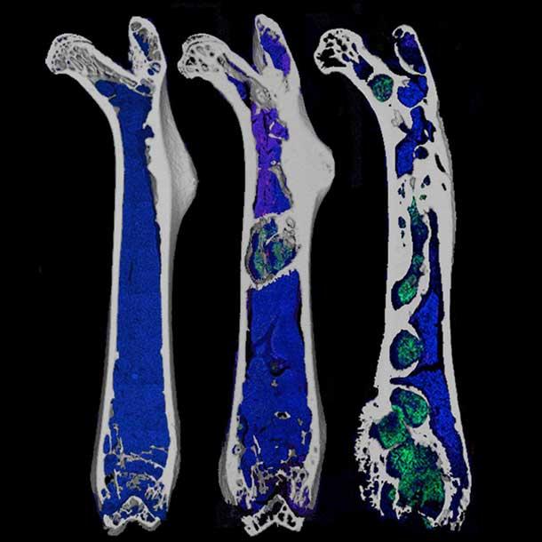 CT scan images showing three femur bones demonstrating progressive stages of prostate cancer metastasis, from early (left) to late stages (right), with green areas indicating tumor cell growth within the bone tissue.