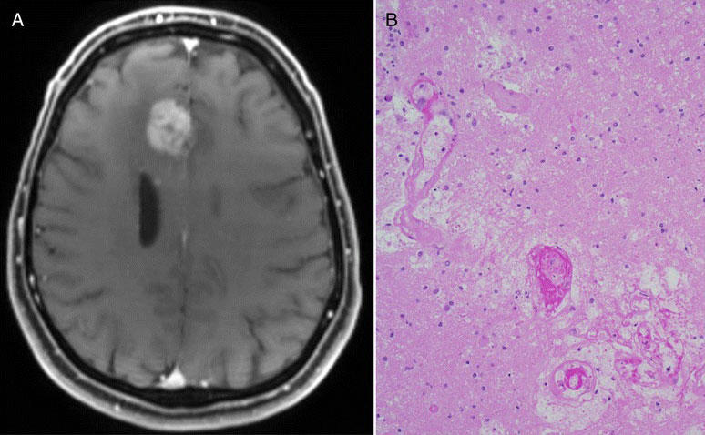 Side-by-side images showing a brain MRI with a glioblastoma tumor (left) and  microscopic tissue section with pseudoprogression features (right).