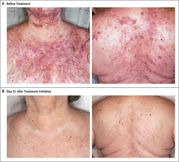 Photographs of a woman with BPDCN skin lesions before and after treatment with tagraxofusp. One photo shows the area between her neck and chest; the other shows her back. Both areas are covered in large, red blotches. The two photos after treatment, which are the same areas of the body, are clear and show none of the blotchiness. 