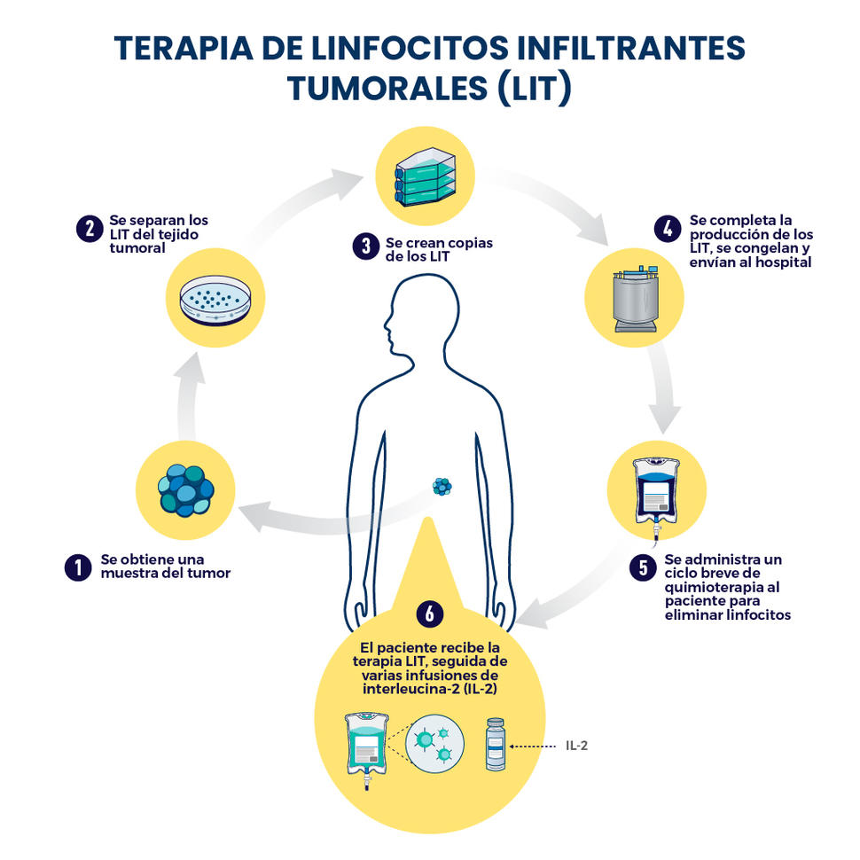 Infografía que describe la terapia de linfocitos infiltrantes tumorales (LIT) desde que se obtiene la muestra del tumor hasta que el paciente recibe la terapia, seguida de las infusiones de interleucina-2.