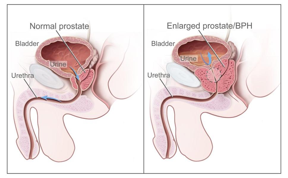 Illustration showing the difference between a normal prostate and an enlarged prostate