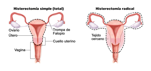 Ilustraciones en las que se compararan la histerectomía simple (total) y la histerectomía radical; en esta última, se observa que es una cirugía más extensa.