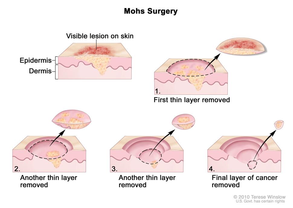  Mohs surgery; drawing shows a visible lesion on the skin. The pullout shows a block of skin with cancer in the epidermis (outer layer of the skin) and the dermis (inner layer of the skin). A visible lesion is shown on the skin’s surface. 