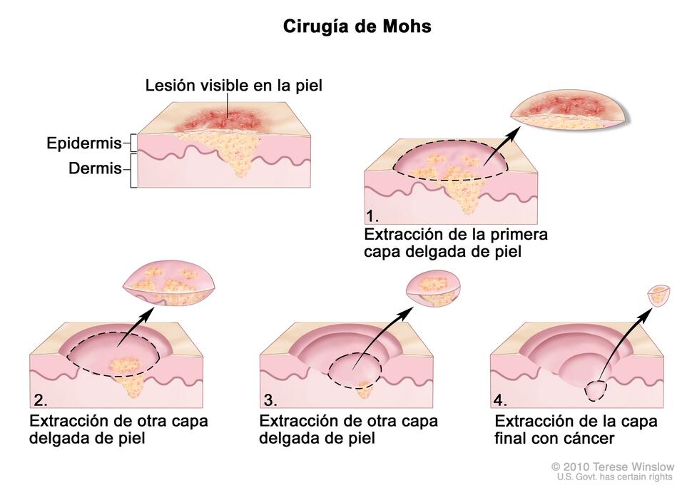 Cirugía de Mohs; el dibujo muestra una lesión visible en la piel. La imagen en detalle muestra un trozo de piel con cáncer en la epidermis (capa exterior de la piel) y la dermis (capa interna de la piel). Se observa una lesión visible en la superficie de la piel.