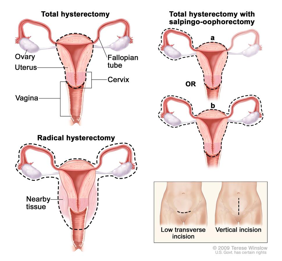 Diagram comparing total, salpingo-oophorectomy, and radical hysterectomy, with dotted lines showing tissues removed and abdominal incision locations.