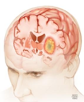 Medical illustration showing a cross-section of a human head with brain anatomy visible, highlighting a yellow-orange glioma tumor within the brain tissue.