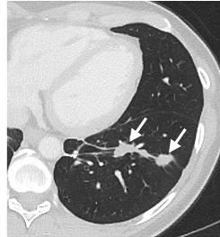 Lung CT scan taken six months after ACT with mutation-specific T-cells, showing shrinkage of metastatic tumors in the lung tissue, with arrows pointing to the reduced tumor sites.