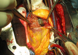 Surgical image showing a metastatic melanoma tumor in the left ventricle of the heart during an operation.