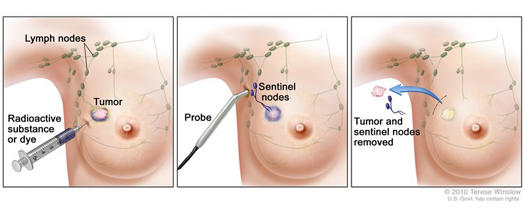 Illustration showing a three-step procedure for sentinel lymph node biopsy in breast cancer treatment. The first panel depicts an injection of a radioactive substance or dye near a tumor to identify lymph nodes. The second panel shows a probe detecting sentinel nodes. The third panel illustrates the removal of the tumor and sentinel nodes.
