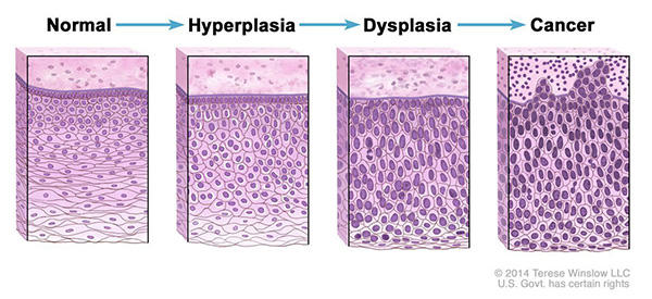 Illustration showing the progression from normal cells to cancer with four panels depicting stages labeled Normal,  Hyperplasia, Dysplasia, and Cancer. The cells becoming increasingly disorganized and abnormal over the course of the diagram. 