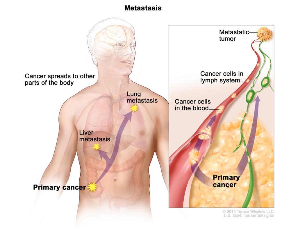 Drawing that shows metastasis, when a primary cancer spreads from its first location to other parts of the body.