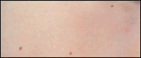 Clinical photograph showing normal benign moles that appear uniformly tan or brown in color