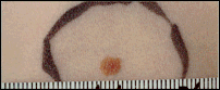 Clinical photograph of a common benign mole with a round, symmetrical shape and clearly defined border, shown next to a ruler for size reference.