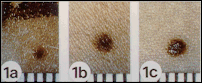 Clinical photographs showing three common benign moles (labeled 1a, 1b, and 1c) that appear as smooth, evenly colored spots on the skin, each shown with a ruler for size reference.