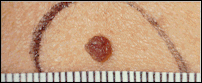 Clinical photograph of a common benign mole measuring less than 5 millimeters (about 1/4 inch) in width, shown with a measurement ruler for size reference.