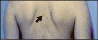 Back view of a person showing several small moles that are common benign moles, with an arrow pointing to one of them for reference.