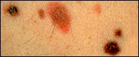 Clinical photograph showing dysplastic nevi (atypical moles) with characteristic mixed coloration of tan, brown, and reddish-pink areas, which differ from normal moles in their irregular color patterns.