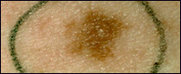 Clinical photograph of a dysplastic nevus showing an irregular, blurred border with color that gradually fades into the surrounding skin.