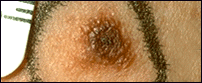 Clinical photograph showing dysplastic nevi with characteristic scaly or pebbly surface textures