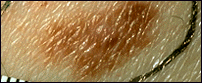 Clinical photograph of a large dysplastic nevus showing the characteristic features of an atypical mole, including irregular borders and uneven coloration.