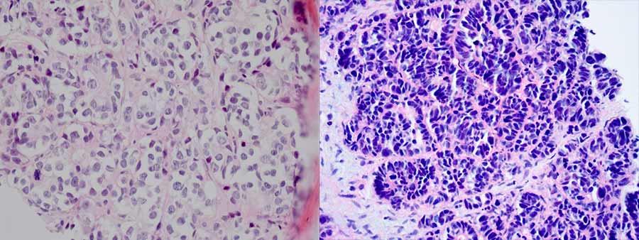 Microscopic comparison showing adenocarcinoma cells on the left and smaller, densely packed t-SCNC cells on the right.