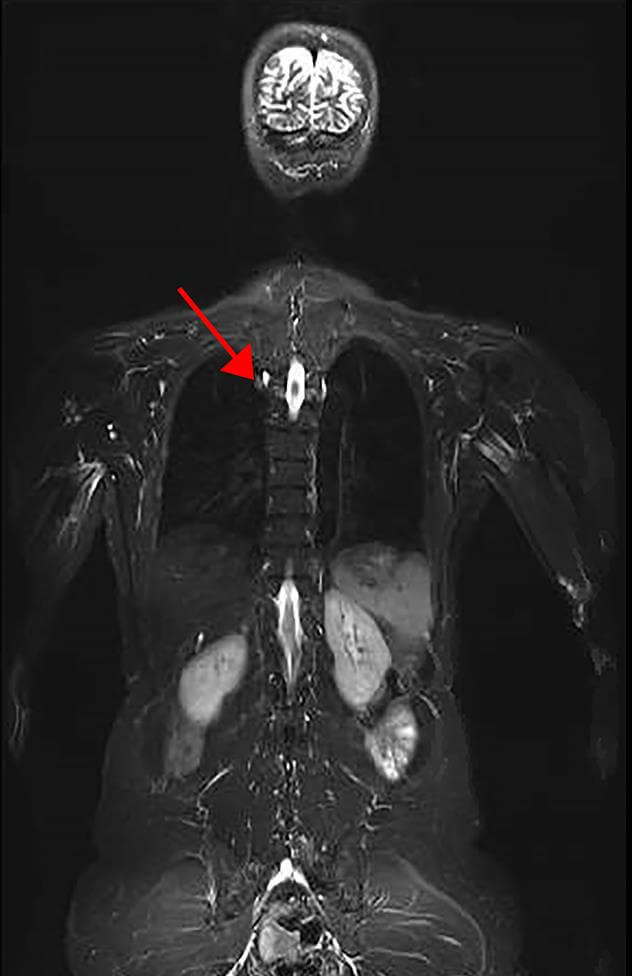 Whole body MRI scan showing lung adenocarcinoma in LFS patient