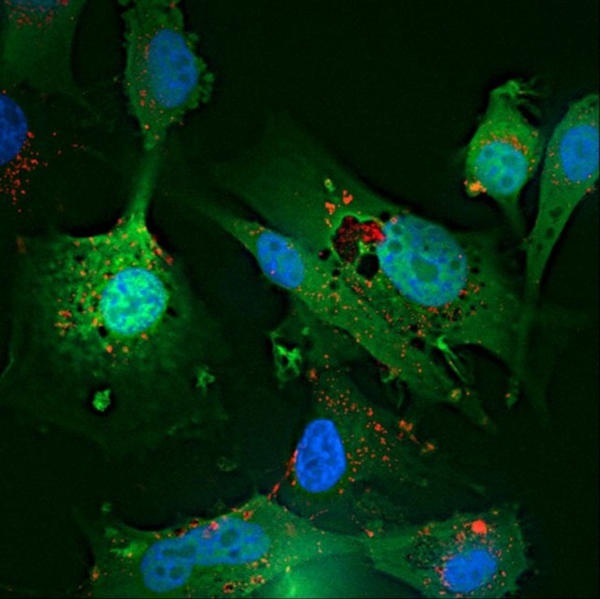 Microscopic image of glioblastoma cells in culture. Various shapes of green fading into black have small areas of light green and blue on top of them. Very small orange and red dots can also be seen.