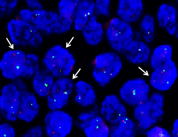 Microscopic view of Ewing sarcoma cells with arrows indicating gene fusions involving the EWS gene.