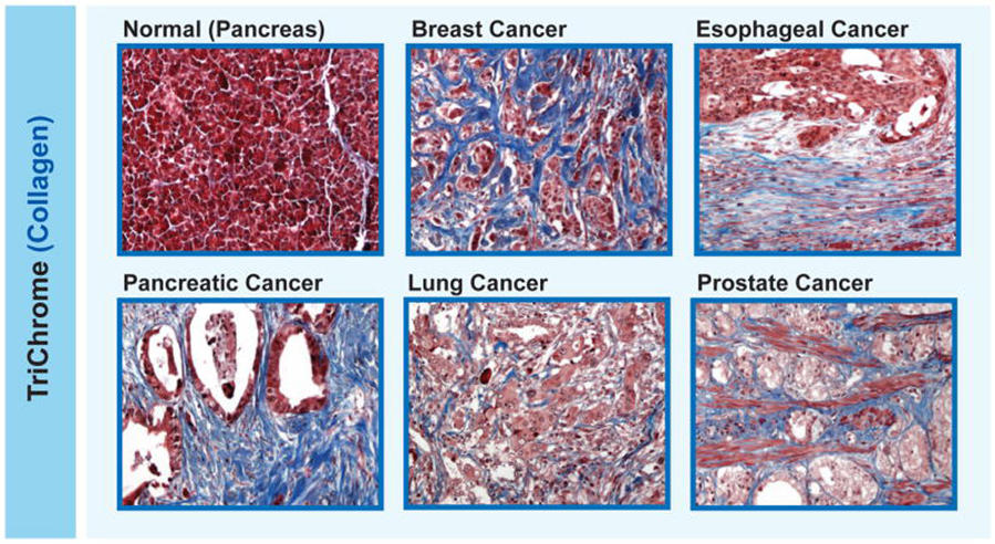 Six histological slides stained with Masson's trichrome to highlight collagen in tissues. Each slide represents a different condition: normal pancreas tissue, breast cancer, esophageal cancer, pancreatic cancer, lung cancer, and prostate cancer. The slides show varying patterns of red (indicating muscle and keratin), blue (indicating collagen), and white spaces (indicating cellular and glandular structures), offering visual insights into the structural differences between healthy and cancerous tissues.