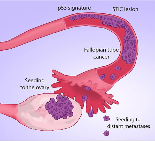 Microscopic view of Ewing sarcoma cells with arrows indicating gene fusions involving the EWS gene.