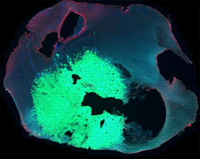 Microscopic image showing a glioma tumor in the brain tissue of a mouse.