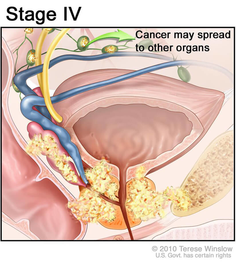 Illustration showing a close-up of the prostate and cancer spreading to other organs, with cancerous areas and lymph nodes highlighted. An arrow indicates the ability for the cancer to spread.