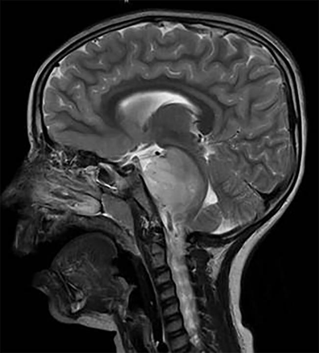 Brain scan showing a DIPG tumor in the brainstem of a child.
