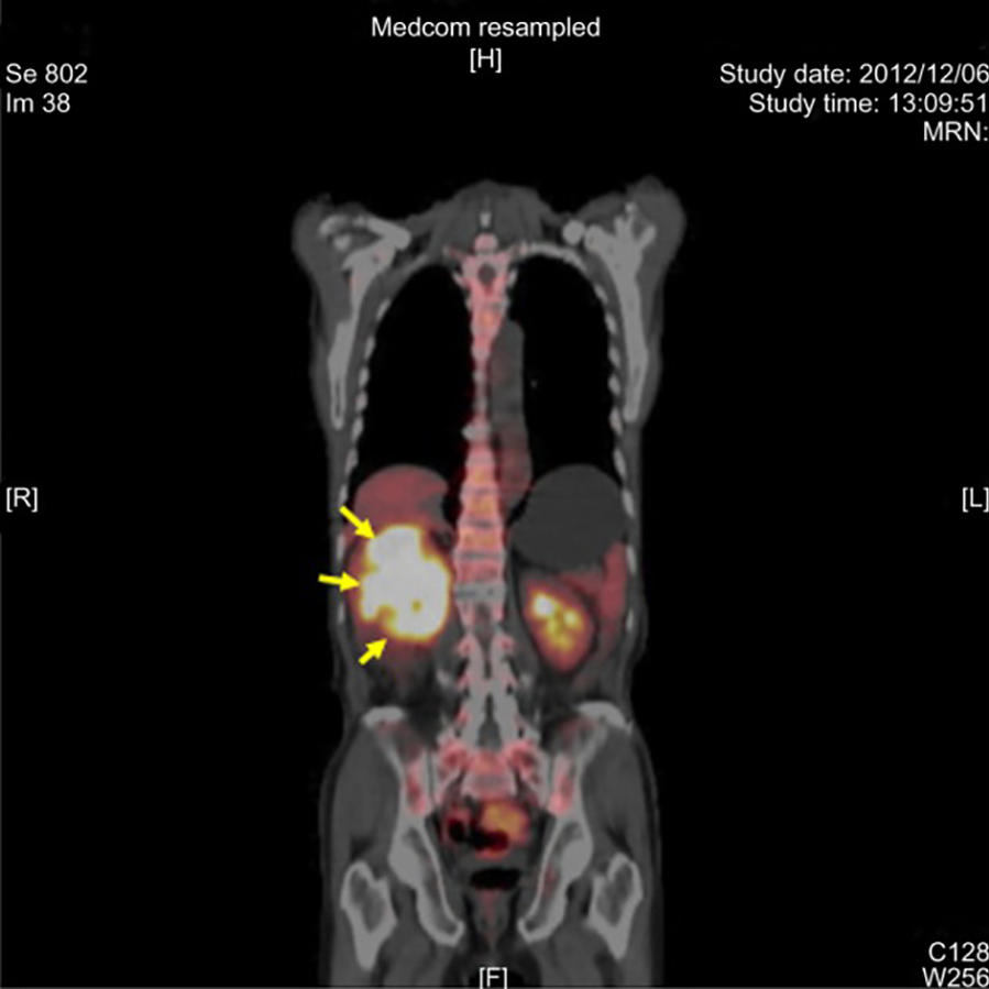 Medical PET scan showing a tumor in the right kidney, highlighted with yellow arrows pointing to the bright yellow-white areas indicating areas of increased metabolic activity typical of cancerous tissue.